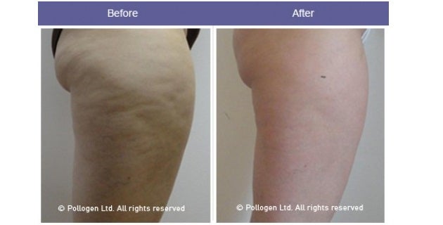 Everything You Need To Know About Cellulite Reduction with RF